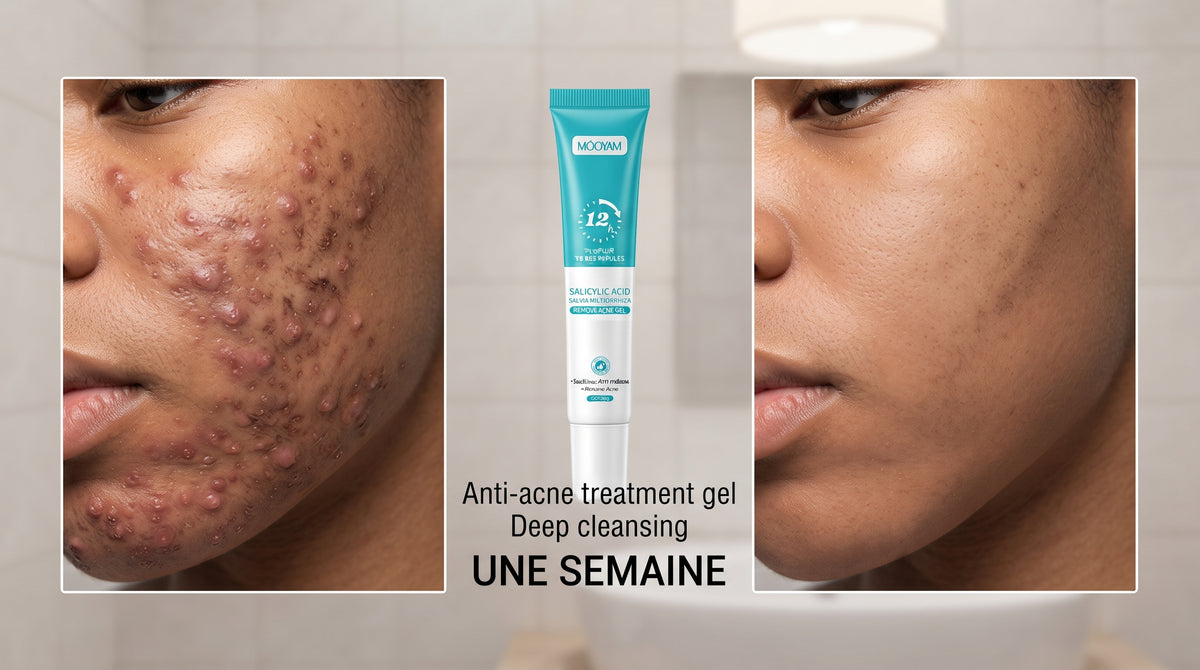 Gel de traitement Anti-Acné, Anti-Taches & Imperfections